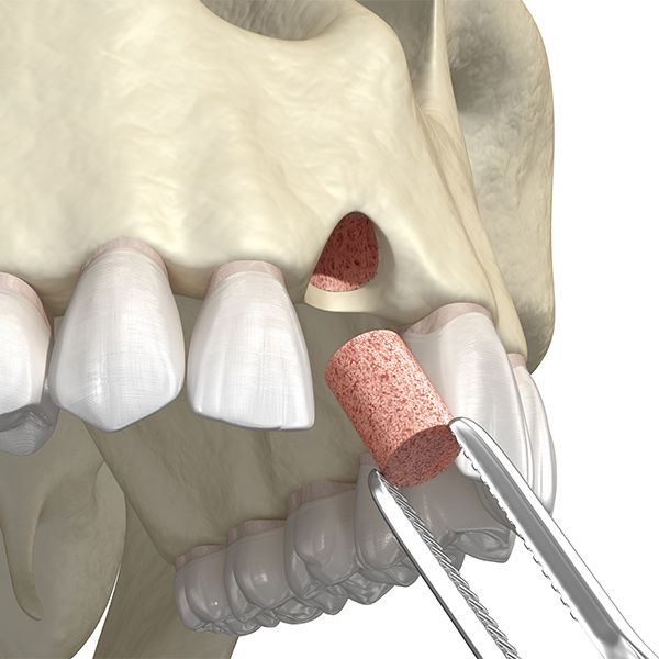 socket graft