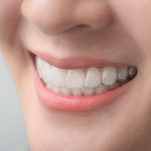 A patient wearing Invisalign aligners