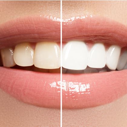 An image showing the contrast between teeth before and after teeth whitening