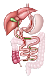 Illustration of duodenal switch surgery
