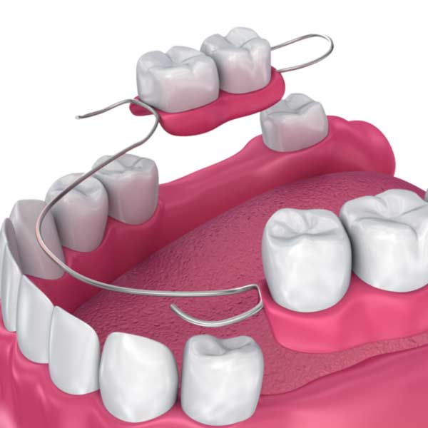 Partial dentures