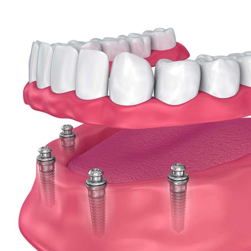 Implant-supported dentures