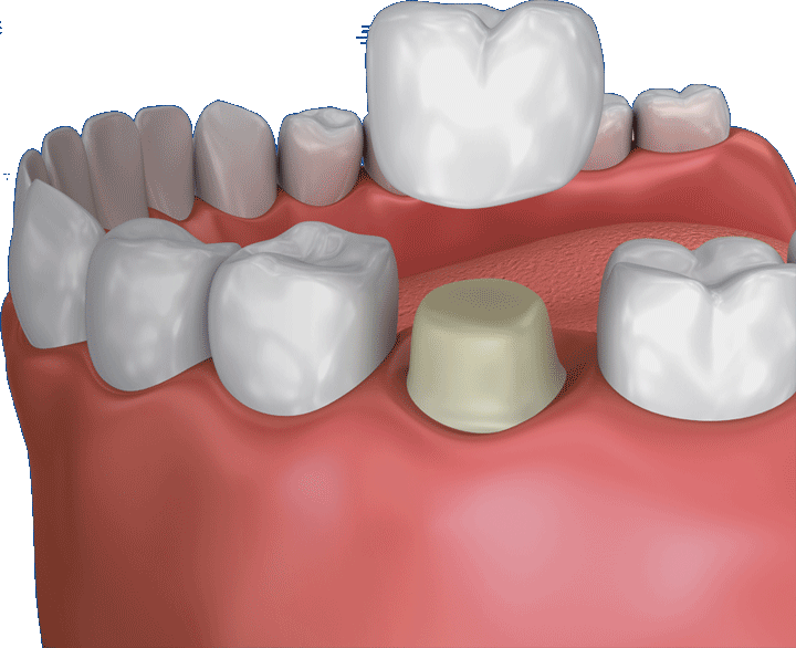 dental crown going over a tooth