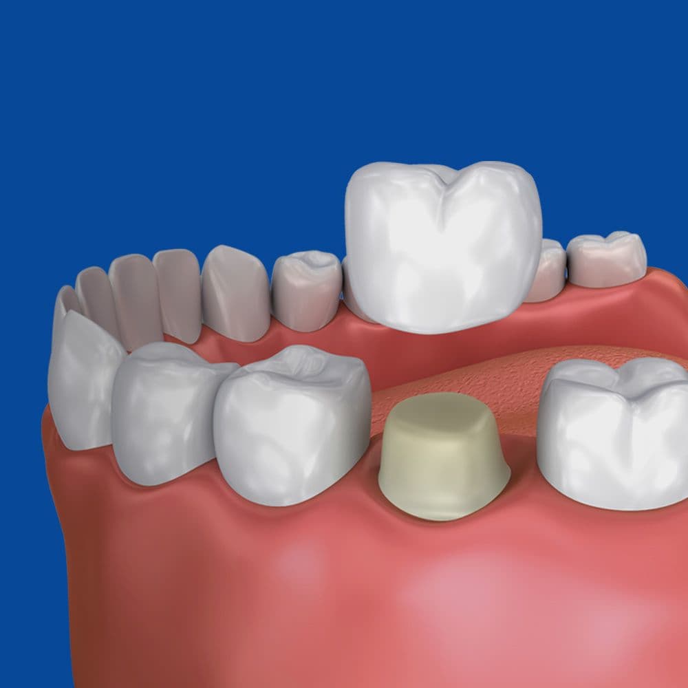 dental crown going over a tooth