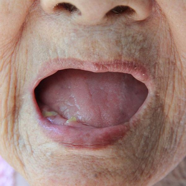 Patient with no teeth