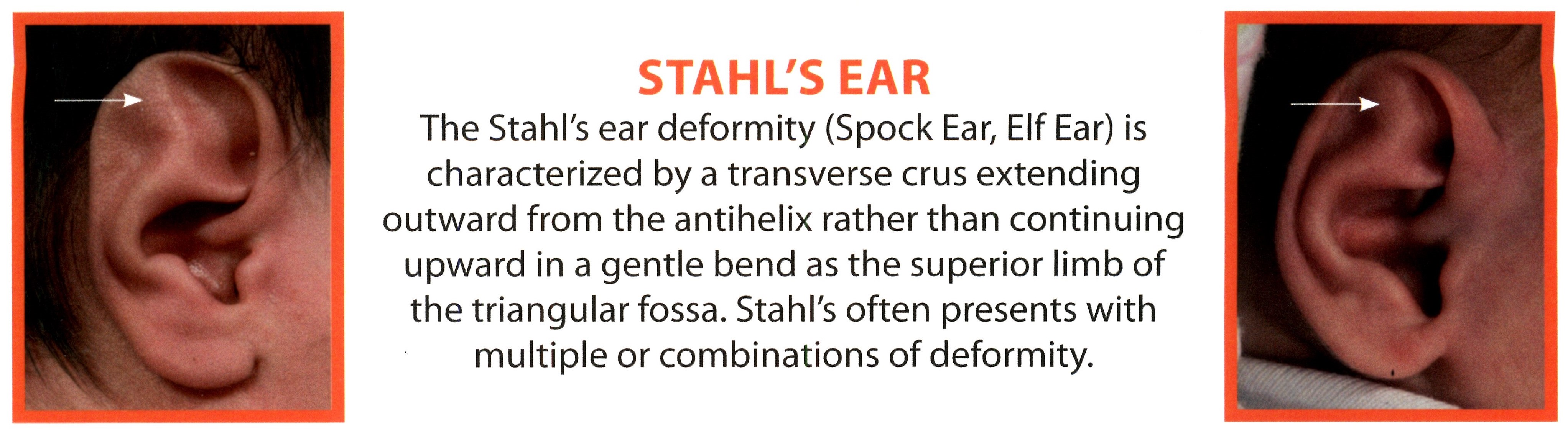 Stahl's Ear Deformity