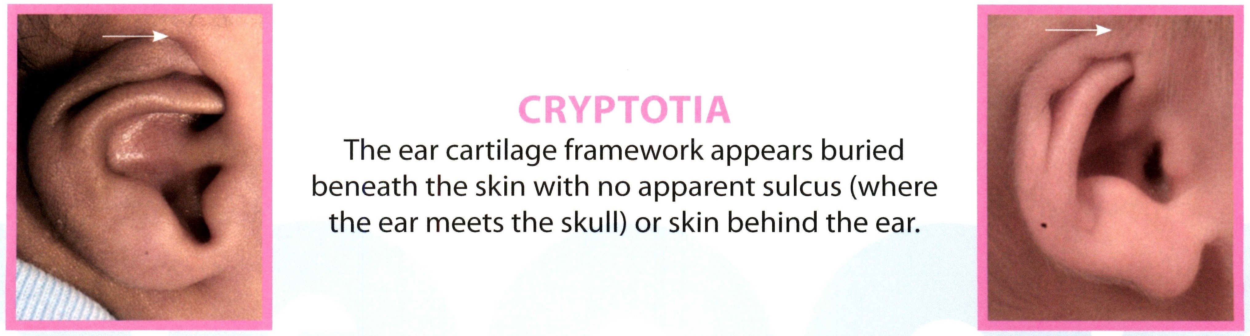 Cryptotia Ear Deformity