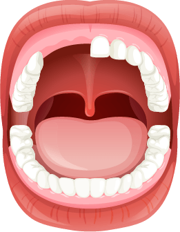 Illustration of missing teeth