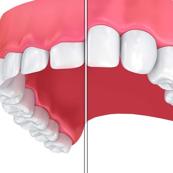 Before and after gum contouring
