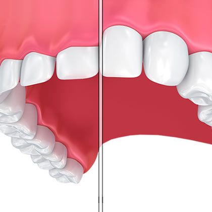 A before and after illustration showing how gum contouring can lengthen the teeth