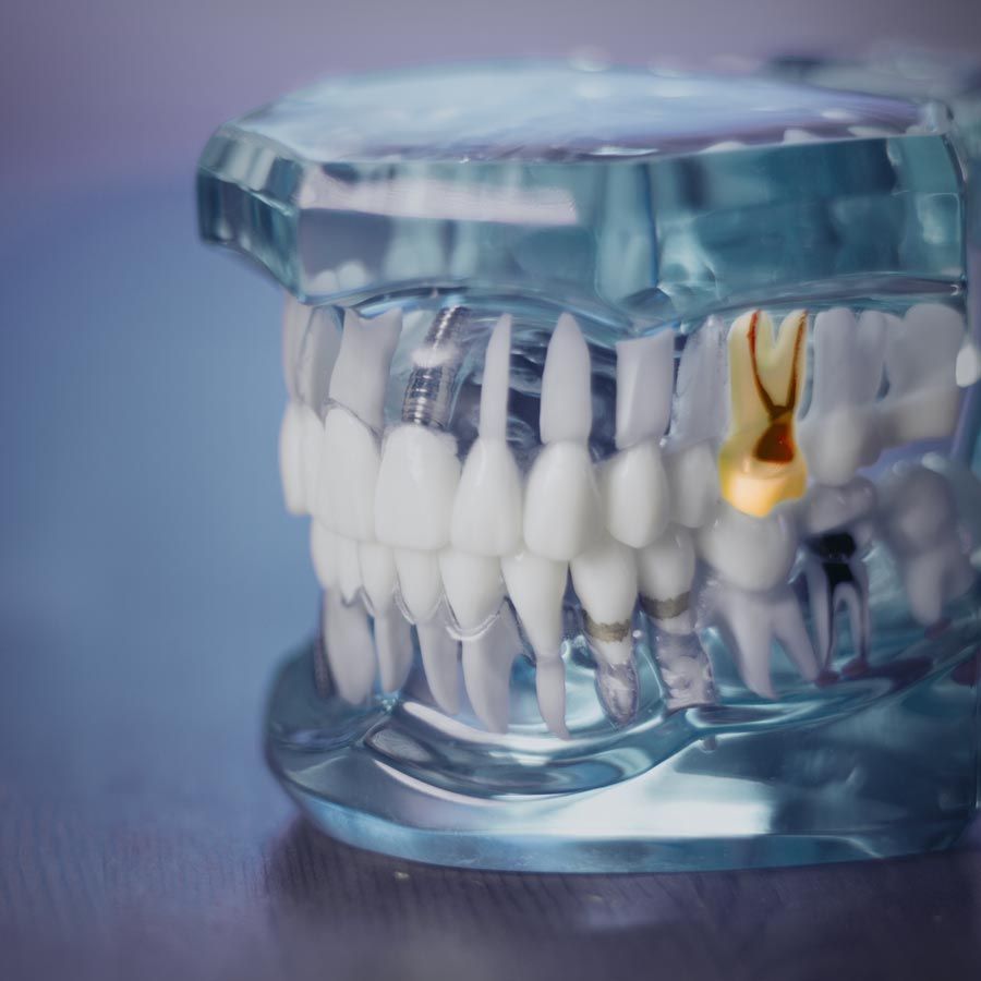 A model of the teeth that shows the root canals