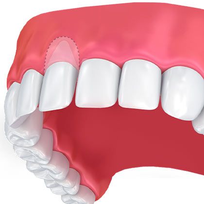 An illustration of the gum recession with a graft overlay