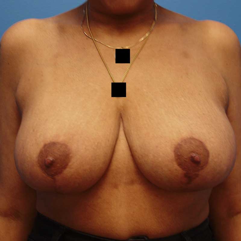 After breast reduction