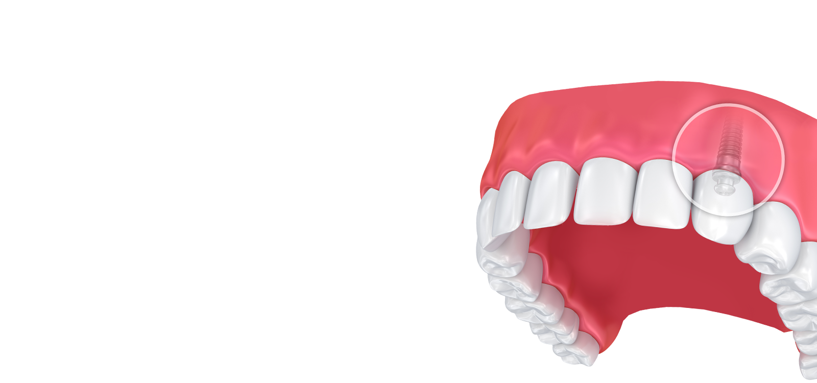Illustration of implant-supported crown in jaw