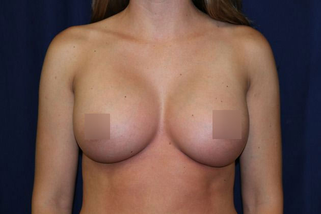 Breast implant after picture