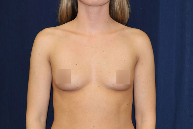 Breast implant before picture