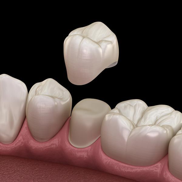 Dental Crowns