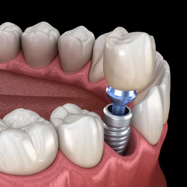 Dental Implants