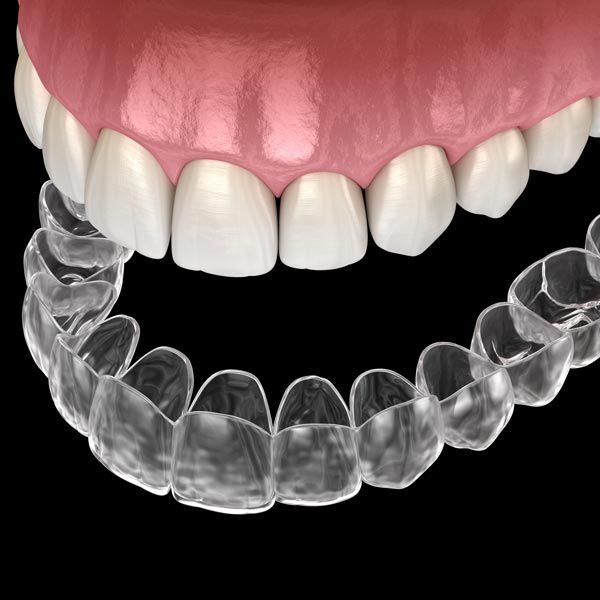 Invisalign