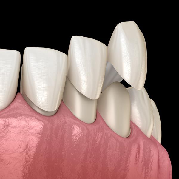 Porcelain Veneers