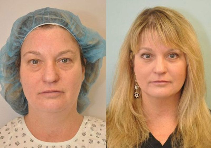 Patient before and after facelift