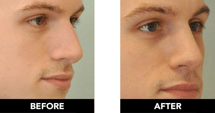 Male rhinoplasty before and after images
