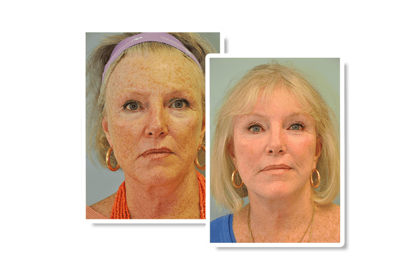 Before and after facelift