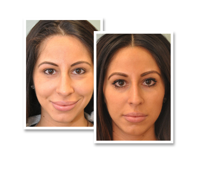 Patient before and after revision rhinoplasty