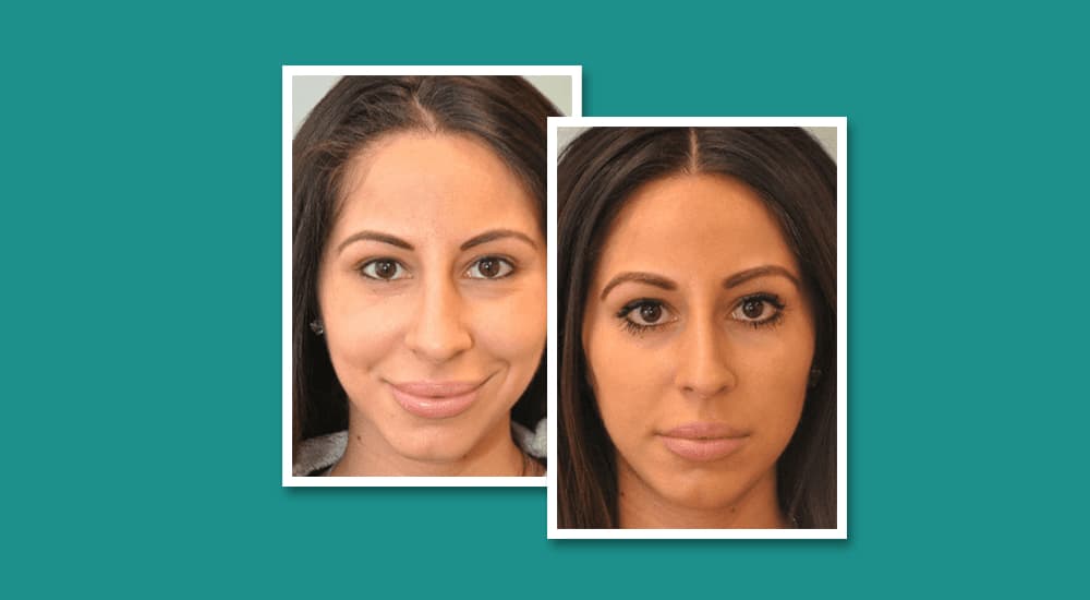Patient before and after revision rhinoplasty