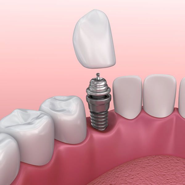 Dental implants