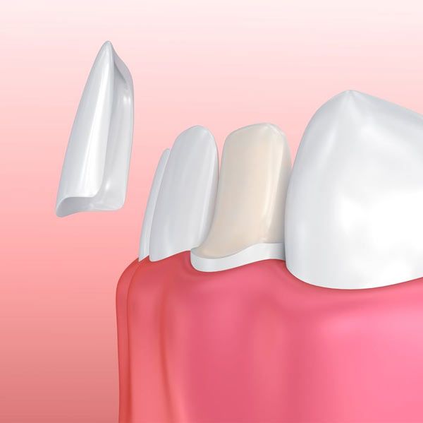 Porcelain veneers