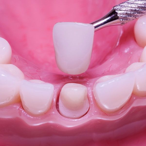 dental crown