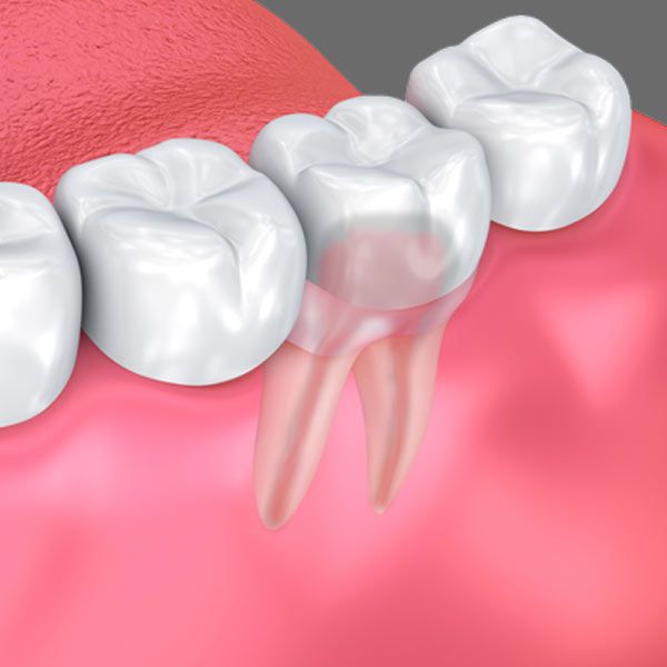 Crown Lengthening