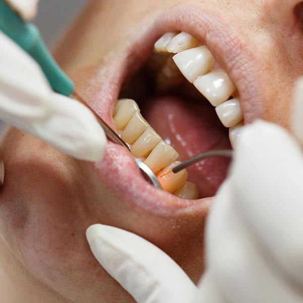 Gingivectomy