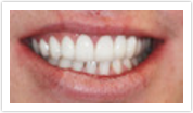after dental care