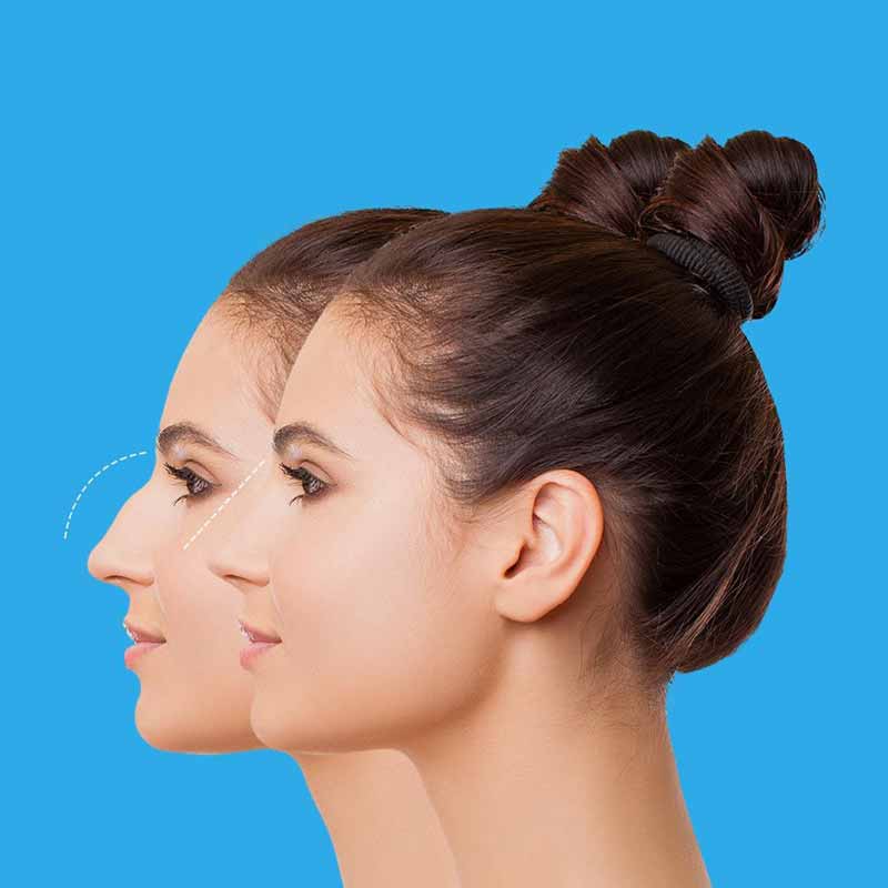 Before and after rhinoplasty