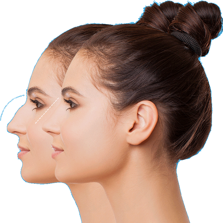 Before and after rhinoplasty
