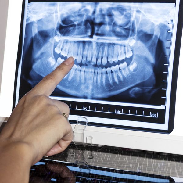 Panoramic X-Rays