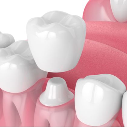 dental crown