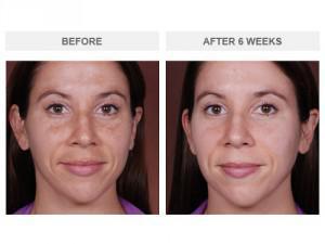 neocutis eye cream before and after