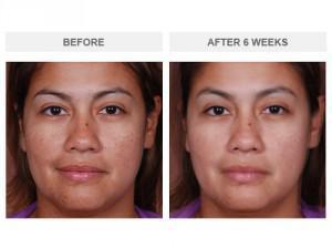 neocutis eye cream before and after